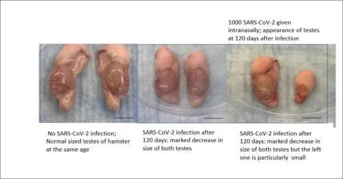 新冠后遗症最新研究:或致性欲减退生育能力降低