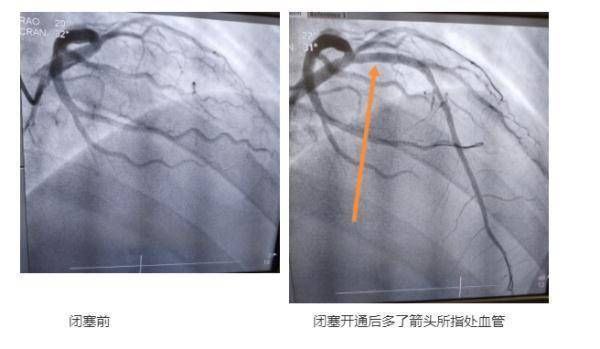 杭州小伙阳了后胸闷，医生一查惊了：你的命可真大