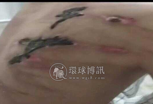 贵州男子在柬埔寨跳楼出逃后讲述“生死三个月”